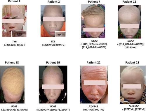 Genotypic spectrum of albinism in Mali