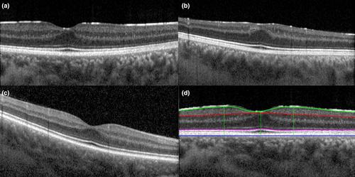 Characteristic deviations of the optic disc and macula in optic nerve hypoplasia based on OCT