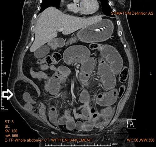 Incarcerated abdomen wall hernia in an elderly patient