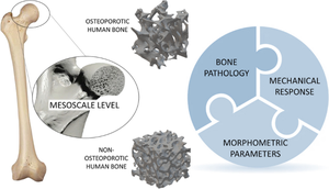 Effect of trabecular architectures on the mechanical response in osteoporotic and healthy human bone.