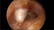 Endoscopic Removal of Petrous Cholesteatoma via Trans-canal Supra-labyrinth Approach: A Case Report