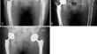 Impact of fixation method on femoral bone loss: a retrospective evaluation of stem loosening in first-time revision total hip arthroplasty among two hundred and fifty five patients.