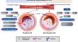 Distinct Challenges of Eruptive and Non-Eruptive Calcified Nodules in Percutaneous Coronary Intervention.