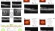 Visual Pathway Recovery Post Pituitary Adenoma Surgery: Insights from Retinal Structure, Vascular Density, and Neural Conduction Analysis.