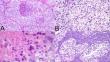 Non-small cell lung carcinoma with clear cell features: a clinicopathologic, immunohistochemical, and molecular study of 31 cases.