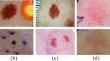 RA-Net: Region-Aware Attention Network for Skin Lesion Segmentation