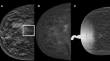 Contrast-enhanced mammography in the management of breast architectural distortions and avoidance of unnecessary biopsies.