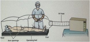 Comment on: does time of intraoperative exposure to the aerobiome increase microbial growth on inflatable penile prostheses?