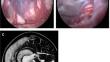 Classification of the relationship between suprasellar arachnoid cyst and hydrocephalus based on treatment modalities: shunting versus neuroendoscopic approaches.