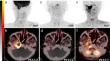 Correction to: A head-to-head comparison of [<sup>68</sup>Ga]Ga-DOTATATE and [<sup>68</sup>Ga]Ga-FAPI PET/CT in patients with nasopharyngeal carcinoma: a single-center, prospective study.