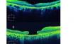 Relationships between causative genes and epiretinal membrane formation in Japanese patients with retinitis pigmentosa.