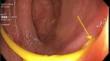 Colonic Perforation from Ventriculoperitoneal Shunt Incidentally Found on Screening Colonoscopy.