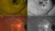 Advancements in Imaging and Therapeutic Options for Dry Age-Related Macular Degeneration and Geographic Atrophy.