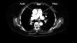 Prognostic value of pulmonary artery diameter/aorta diameter ratio in patients with acute pulmonary embolism.