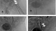 Successful Percutaneous Revascularization for Femoral Artery Occlusion After Catheter Intervention: Serial Case Report