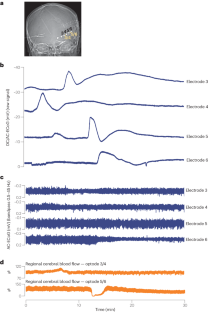 From spreading depolarization to blood–brain barrier dysfunction: navigating traumatic brain injury for novel diagnosis and therapy