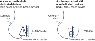 Transcatheter treatment of pure aortic regurgitation