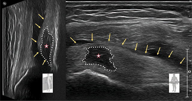 Prefemoral Fat Pad Impingement Syndrome: Correlation between Ultrasonography and Magnetic Resonance Imaging.