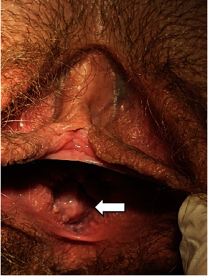 Davydov Vaginoplasty in Mayer-Rokitansky-Küster-Hauser Syndrome Patient Presenting With Urethral Dilatation.