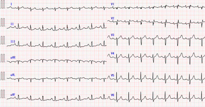Second-degree atrioventricular block induced by electrical stimulation of transcranial motor-evoked potential: a case report.