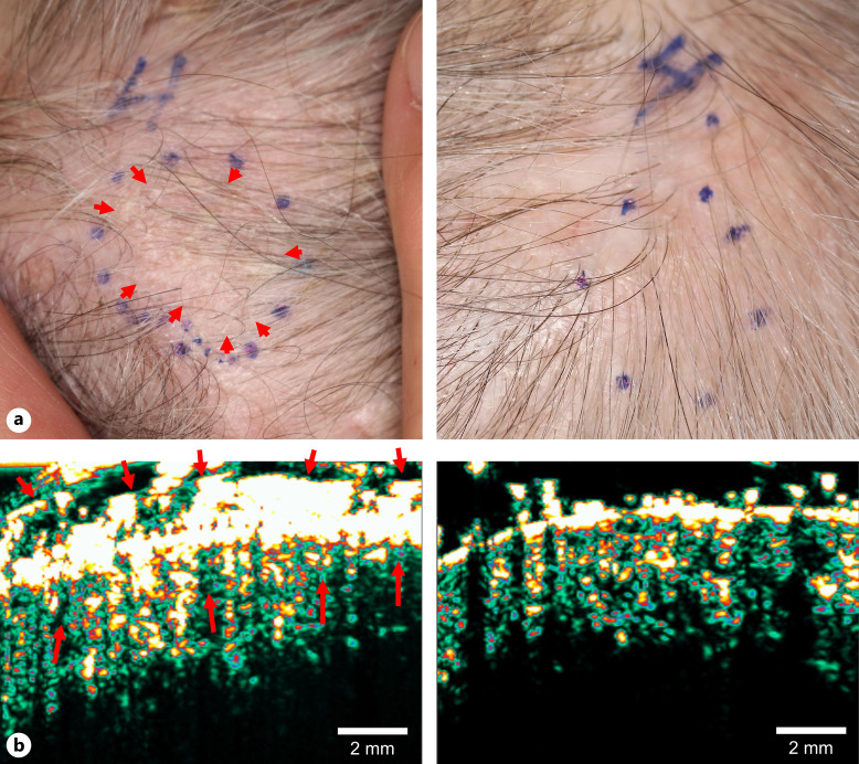 Recalcitrant Basal Cell Carcinoma after Grenz Ray Therapy: Introduction of High-Intensity Focused Ultrasound for Minimally Invasive Management.