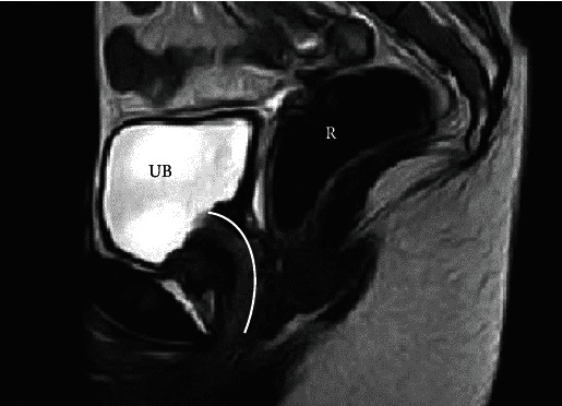 Davydov Vaginoplasty in Mayer-Rokitansky-Küster-Hauser Syndrome Patient Presenting With Urethral Dilatation.