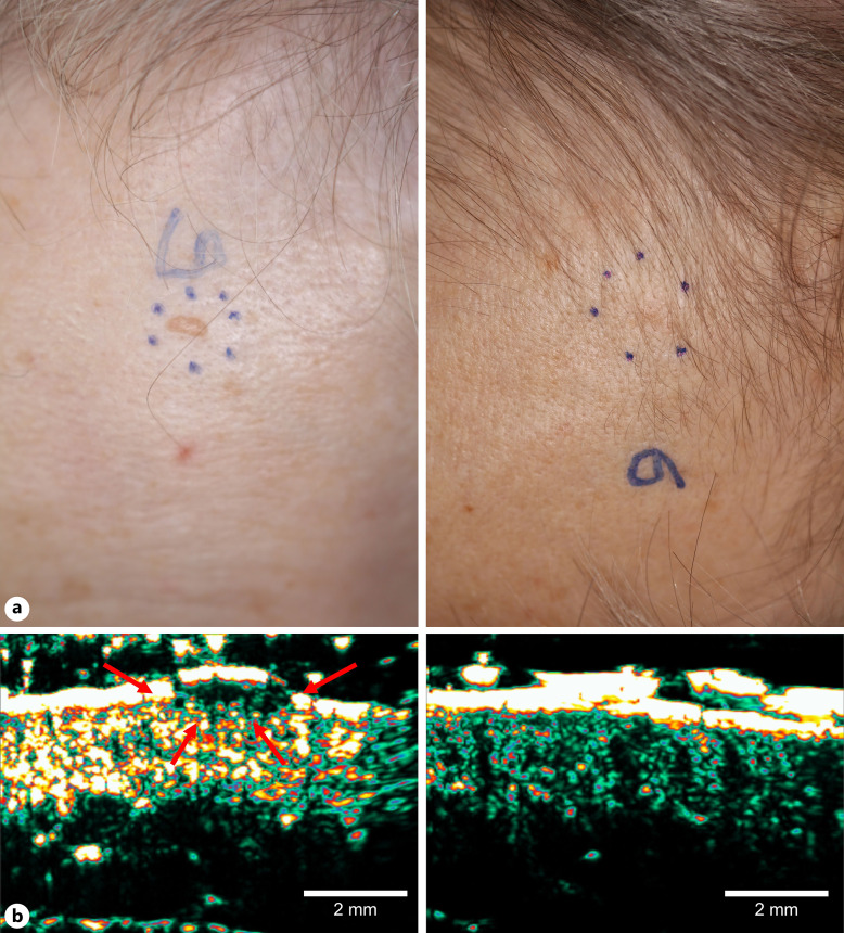 Recalcitrant Basal Cell Carcinoma after Grenz Ray Therapy: Introduction of High-Intensity Focused Ultrasound for Minimally Invasive Management.