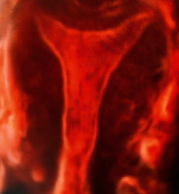 Spontaneous Pregnancy after 4D-Hysterosalpingo-Sonography (HyCoSy) in the Same Menstrual Cycle: A Case Report and an Updating Review of the Current Literature regarding the Positive Impact of Tubal Flushing Effect on Fertility.