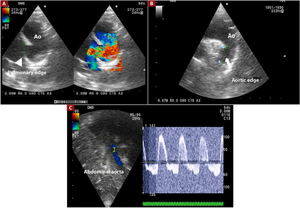Use of echocardiography in percutaneous closure of patent ductus arteriosus at the Instituto Nacional de Salud del Niño, San Borja, Lima - Peru.