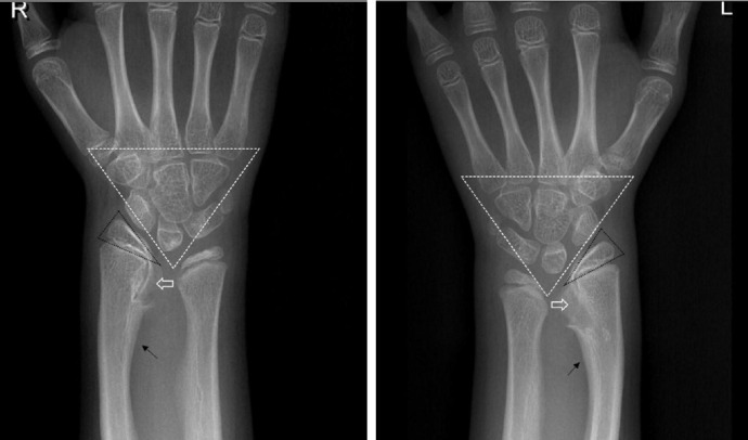 Identification of a novel mutation of the SHOX gene in a patient with Leri-Weill dyschondrosteosis accompanied by growth hormone deficiency.