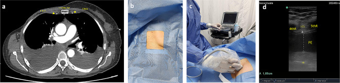 Off-plane technique ultrasound-guided pericardiocentesis via anterior approach: short communication.