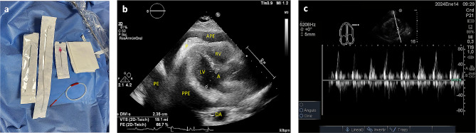 Off-plane technique ultrasound-guided pericardiocentesis via anterior approach: short communication.