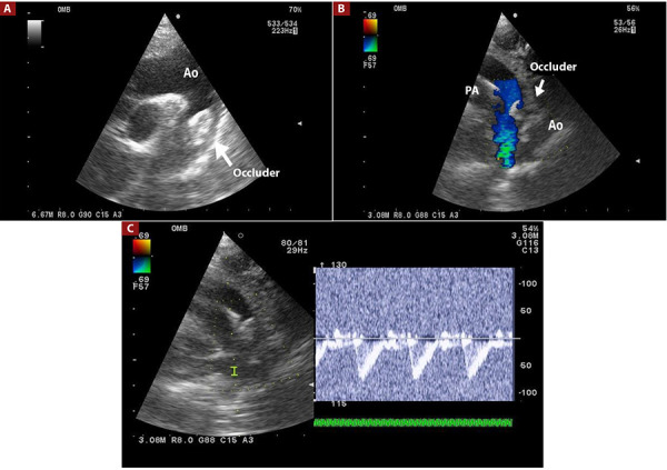 Use of echocardiography in percutaneous closure of patent ductus arteriosus at the Instituto Nacional de Salud del Niño, San Borja, Lima - Peru.