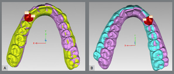 Accuracy of arch expansion with two thermoplastic materials in Invisalign® patients: EX30® and SmartTrack®.