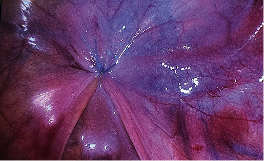 Davydov Vaginoplasty in Mayer-Rokitansky-Küster-Hauser Syndrome Patient Presenting With Urethral Dilatation.