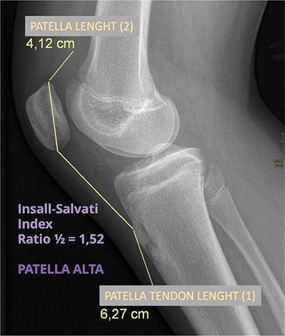 Prefemoral Fat Pad Impingement Syndrome: Correlation between Ultrasonography and Magnetic Resonance Imaging.