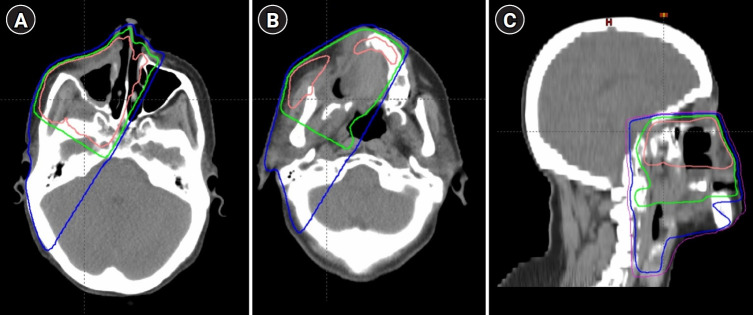 The role of histology on the outcome of sinonasal carcinomas treated with radiotherapy: a single institution experience.