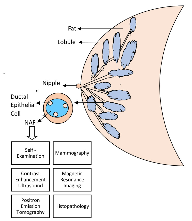Early detection of breast cancer through the diagnosis of Nipple Aspirate Fluid (NAF).