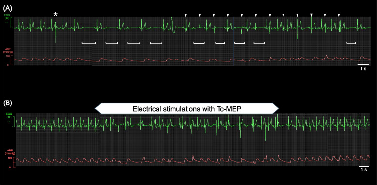 Second-degree atrioventricular block induced by electrical stimulation of transcranial motor-evoked potential: a case report.