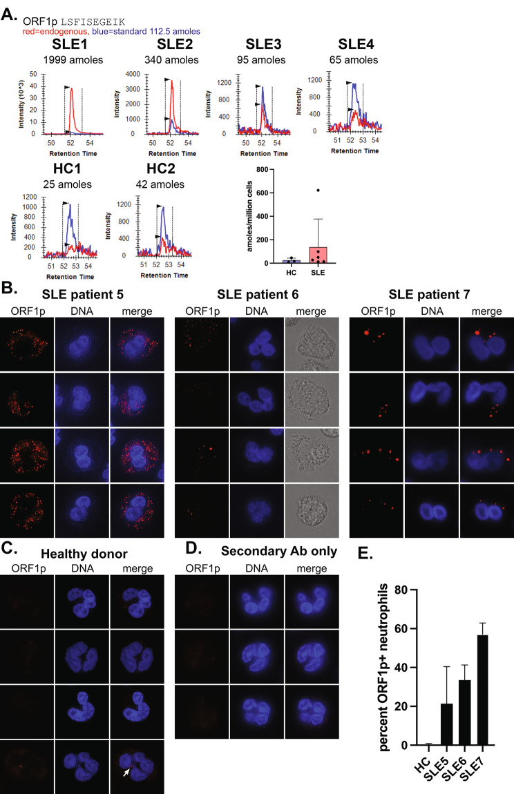 Subcellular location of L1 retrotransposon-encoded ORF1p, reverse transcription products, and DNA sensors in lupus granulocytes.