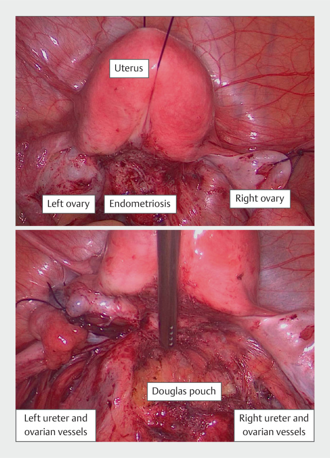 The Hallmarks of Endometriosis.