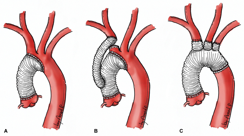 Innominate Artery Translocation with Hemiarch Replacement Strategy for Acute Type A Aortic Dissection: a Single-Center Study.