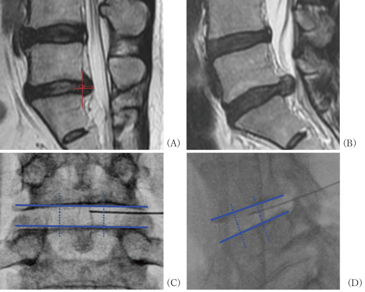 Immediate Effects, Detailed Clinical Outcomes, and Prognostic Factors of Chemonucleolysis Using Condoliase for Lumbar Disc Herniation.