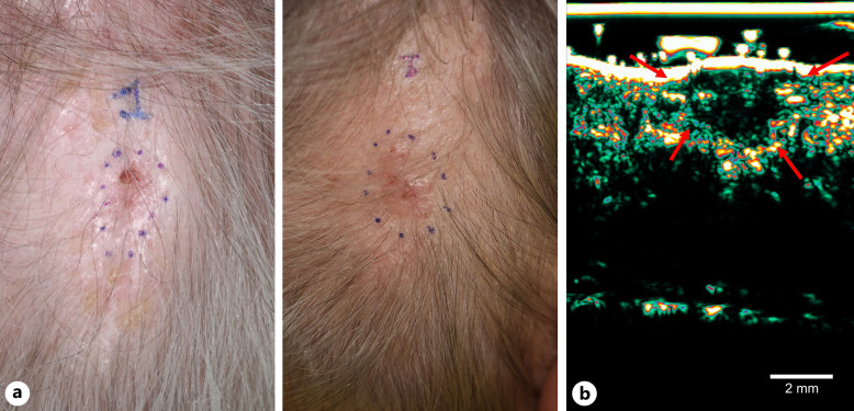 Recalcitrant Basal Cell Carcinoma after Grenz Ray Therapy: Introduction of High-Intensity Focused Ultrasound for Minimally Invasive Management.