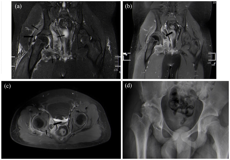 Is choice of approach associated with risk of avascular necrosis in pediatric septic hip?