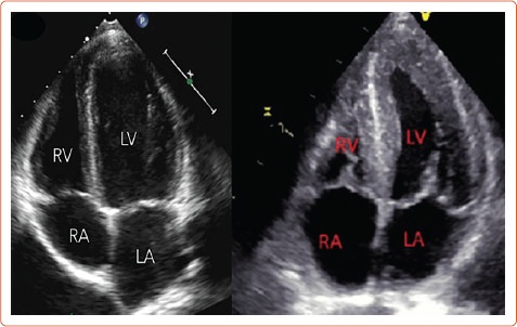 Maternal Cardiac Function in Pregnancies with Metabolic Disorders.