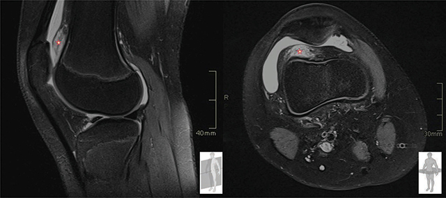 Prefemoral Fat Pad Impingement Syndrome: Correlation between Ultrasonography and Magnetic Resonance Imaging.