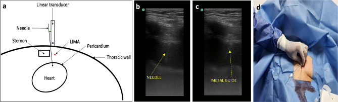 Off-plane technique ultrasound-guided pericardiocentesis via anterior approach: short communication.