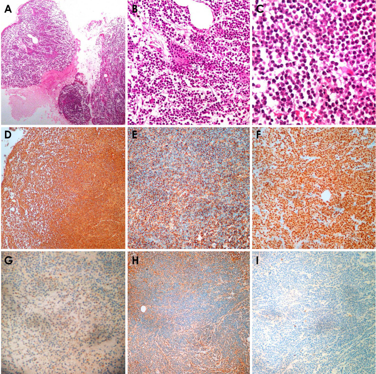 Beyond the mouth: Uncovering non-secretory multiple myeloma through oral symptoms.
