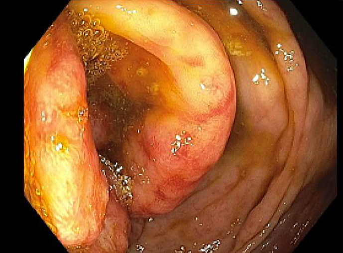 Gastrointestinal Symptom-Free Multiple Lymphomatous Polyposis: An Atypical Case Presentation of Mantle Cell Lymphoma.